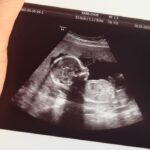 Conexiunea între diabetul gestational și posibilele riscuri de autism sau ADHD la făt 3 legatura dintre diabetul in timpul sarcinii si riscul de autism sau adhd al fatului 67f8dac238e0d