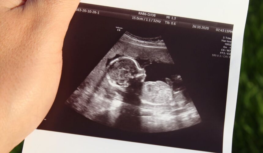 Conexiunea între diabetul gestational și posibilele riscuri de autism sau ADHD la făt 1 legatura dintre diabetul in timpul sarcinii si riscul de autism sau adhd al fatului 67f8dac238e0d