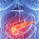 O inovație promițătoare: un test capabil să identifice cancerul pancreatic în faze timpurii 2 un nou test ar putea depista cancerul pancreatic in stadiile initiale 6851c299ad9ab