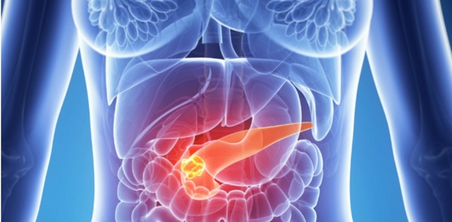 O inovație promițătoare: un test capabil să identifice cancerul pancreatic în faze timpurii 1 un nou test ar putea depista cancerul pancreatic in stadiile initiale 6851c299ad9ab