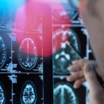 Un nou tratament promițător pentru Alzheimer în faze incipiente se apropie de aprobat în Uniunea Europeană: Descoperiți donanemab! 2 un medicament pentru tratarea bolii alzheimer in stadii timpurii este aproape de autorizare in ue ce este donanemab 68861aa01ca24