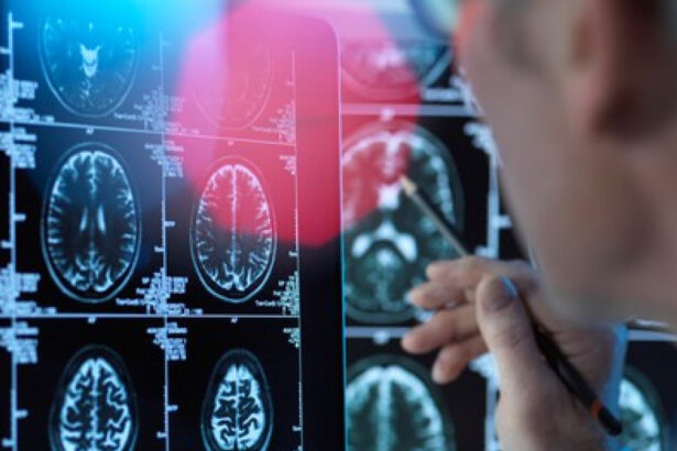 un medicament pentru tratarea bolii alzheimer in stadii timpurii este aproape de autorizare in ue ce este donanemab 68861aa01ca24