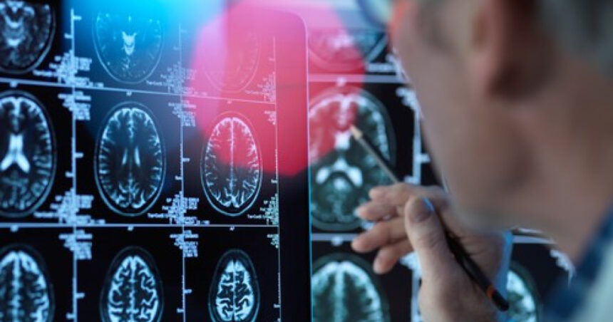 Un nou tratament promițător pentru Alzheimer în faze incipiente se apropie de aprobat în Uniunea Europeană: Descoperiți donanemab! 1 un medicament pentru tratarea bolii alzheimer in stadii timpurii este aproape de autorizare in ue ce este donanemab 68861aa01ca24