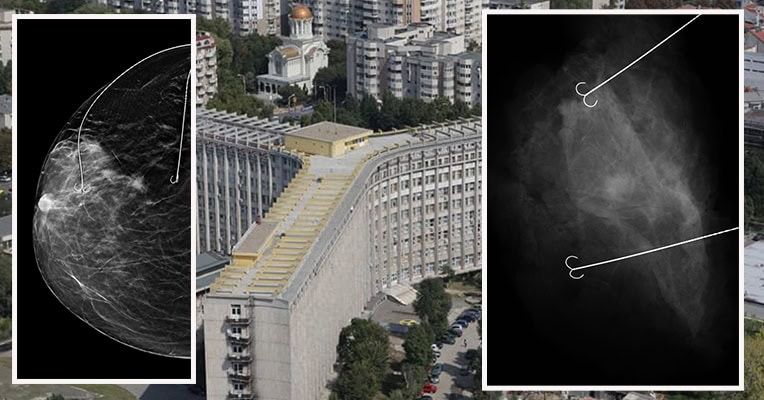 Inovație în tratamentul afecțiunilor mamare la Spitalul Clinic Județean de Urgență Constanța 1 premiera medicala in patologia mamara la spitalul clinic judetean de urgenta constanta 689369240f2ed