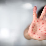 Confruntarea susținătorilor lui Trump cu cercetarea științifică: vaccinul împotriva rujeolei exclude recomandările experților medicali 2 lupta oamenilor lui trump cu stiinta vaccinul contra rujeolei nu mai este recomandat contrar avizelor medicilor 68cd1a60bf155