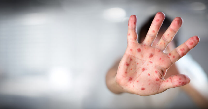 Confruntarea susținătorilor lui Trump cu cercetarea științifică: vaccinul împotriva rujeolei exclude recomandările experților medicali 1 lupta oamenilor lui trump cu stiinta vaccinul contra rujeolei nu mai este recomandat contrar avizelor medicilor 68cd1a60bf155