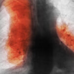 Proiecții alarmante: Creșterea îngrijorătoare a deceselor din cauza cancerului până în 2050. Cele mai răspândite și letale tipuri (studiu) 3 numarul deceselor cauzate de cancer ar urma sa creasca semnificativ pana in 2050 cele mai frecvente si cele mai mortale studiu 68d5004aa812a
