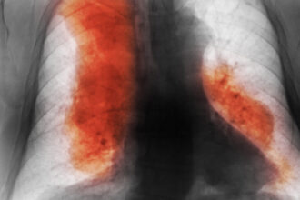 numarul deceselor cauzate de cancer ar urma sa creasca semnificativ pana in 2050 cele mai frecvente si cele mai mortale studiu 68d5004aa812a