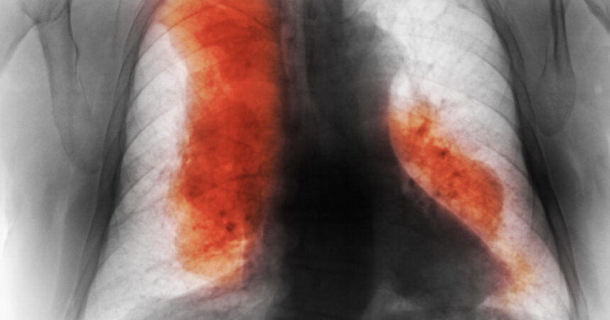 Proiecții alarmante: Creșterea îngrijorătoare a deceselor din cauza cancerului până în 2050. Cele mai răspândite și letale tipuri (studiu) 1 numarul deceselor cauzate de cancer ar urma sa creasca semnificativ pana in 2050 cele mai frecvente si cele mai mortale studiu 68d5004aa812a