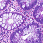 Impactul tot mai mare al cancerului de colon asupra tinerilor: descoperiri recente despre cauzele acestui fenomen îngrijorător 2 cum a ajuns cancerul de colon sa afecteze tot mai multi tineri si care este cauza principala indicata de studii 68eac6c0a5cb2