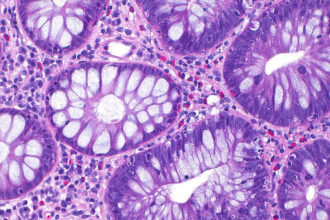 cum a ajuns cancerul de colon sa afecteze tot mai multi tineri si care este cauza principala indicata de studii 68eac6c0a5cb2