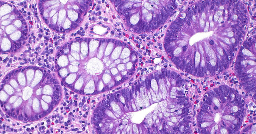 Impactul tot mai mare al cancerului de colon asupra tinerilor: descoperiri recente despre cauzele acestui fenomen îngrijorător 1 cum a ajuns cancerul de colon sa afecteze tot mai multi tineri si care este cauza principala indicata de studii 68eac6c0a5cb2