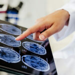 video premiera medicala la spitalul bagdasar arseni din bucuresti operatie pe creier cu pacientul treaz a fost foarte curajos 691c22f19a7e8