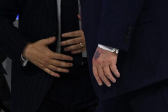 video eu iau aspirina mare trump ofera explicatii pentru cea mai noua vanataie care i a aparut pe mana 69731f34cc574